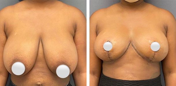 Breast lift before and after by Dr. Ary Krau