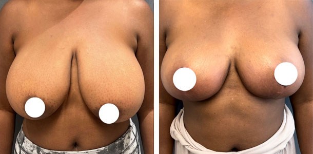 Breast lift before and after by Dr. Ary Krau