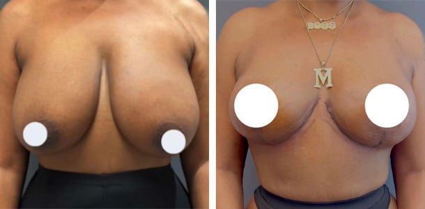 Breast lift before and after by Dr. Ary Krau