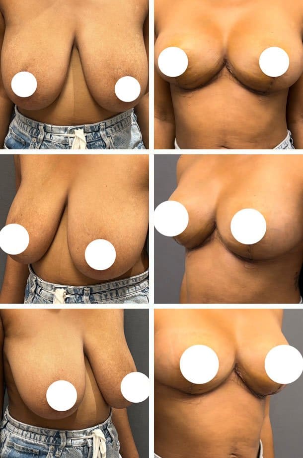 Breast surgery result by Dr. Ary Krau